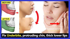 Check spelling or type a new query. 5 Exercises Fix Underbite Without Surgery Fix Protruding Chin Reduce Thick Lower Lip Youtube