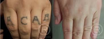 Two tattoo removal sessions for up to three, six, or eight sq in. Dermatology Renewal Laser Clinic Minneapolis Mn