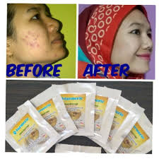 Cara memilih masker wajah untuk kulit berjerawat. Masker Jerawat Kunyit Putih Q Turmeric Untuk Kulit Berminyak Obat Jerawat Shopee Indonesia