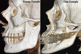 The main component of bone is bone matrix, which is a mixture of a fibrous protein called collagen and carbonated hydroxyapatite, an inorganic compound mos the main component of bone is bone matrix, which is a mixture of a fibrous protein c. Our Face Bones Change Shape As We Age Live Science