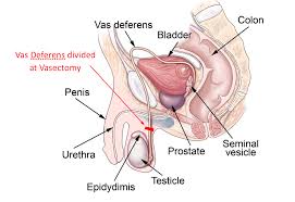 Vasectomy South West Sydney Urology