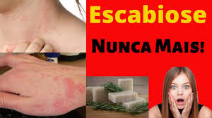 Escabiose infecções pelo ácaro sarcoptes scabiei var. Remedio Para Escabiose Acabe Com A Escabiose Usando Esse Remedio Youtube