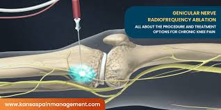 Image result for Radiofrequency Surgery