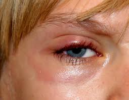 Ursachen Fur Ein Rotes Auge Auge Online