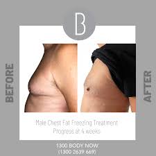 Man Boob Surgery (Gynecomastia): Can Fat Freezing Help?