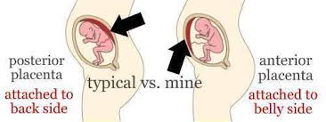 Kicks Count What Is An Anterior Placenta And What Does This Mean For Baby Movements The Placenta Develops Wherever The Fertilised Egg Embeds Into Your Uterus An Anterior Placenta Is When