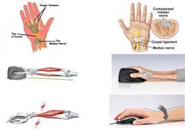 Dolor De Muneca Por Utilizar El Raton