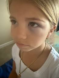 Anyone know how to get a black eye to go away in ONE DAY? 😭😢😭