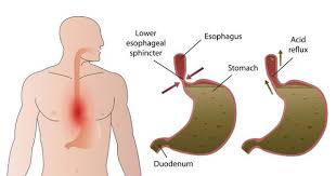 What Is Esophageal Achalasia With Pictures Bile Reflux Reflux Heart Burn Remedy