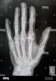 Image result for Hand XRay