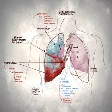 Hemoneumotórax y atelectasia compresiva