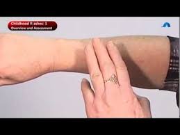 Other skin lesions associated with hsp include large hives (urticarial wheals) or ulcers (necrotic), especially on the buttocks and legs. Identifying Petechiae Youtube