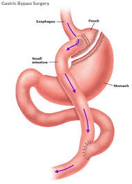 gastric byp surgery for weight loss