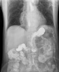 Let's take a look at some of the most common symptoms that result from having low stomach acid. Gastroesophageal Reflux Disease Wikipedia