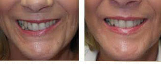 How to repair a crooked nose. How To Fix A Crooked Smile Nlw