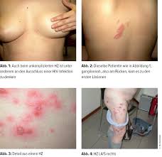 Immer einen arzt oder spezialisten für. Herpes Zoster Im Uberblick Allgemeinmedizin Universimed Medizin Im Fokus