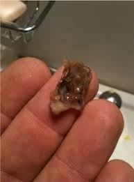 If you do it after feeding him, the reaction between mucous and normal saline can cause nausea and vomiting. Joe Rogan On Twitter Still Blowing These Giant Boogers Out Of My Nose Following Last Months Operation Don T Look If You Can T Take It Http Twitpic Com Dt219