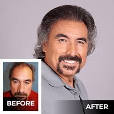 Hair clearance Transplants in NYC Maxim