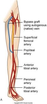 Femoral Popliteal Bypass Graft Around An Occluded Superficial Femoral Artery Vascular Surgery Vascular Ultrasound Vascular