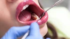 Remember, the main benefit of a dental gauze is to help in the formation of blood clots. Wisdom Teeth What To Expect After The Extraction Vital Record