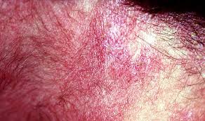 But this still accounts for a minority of new cases. Lung Cancer Symptoms Signs Of A Tumour Include An Itchy Rash On Your Skin Express Co Uk