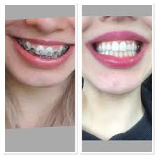 Food then enters your large intestine (colon) for further digestion, absorption of water and, finally, elimination of undigested food. Got My Braces Off Today I Feel Amazing Braces