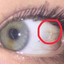 Netzhaut Lost Sich Ab Augen Gesicht Augapfel