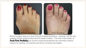 Bunion surgery for minor bunion deformities can be attempted utilizing a minimally invasive bunion approach by making a small incision to either shave down the prominent bone and/or break the bone to shift it into its correct position, and then fixate the bone with screws through another small incision. Bunions Before And After Photos Youtube