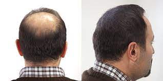 Ckm Super Billion Hair Ile Sadece 10 Saniyede Saca Hacim Kazandirin Keratin Sac Essiz