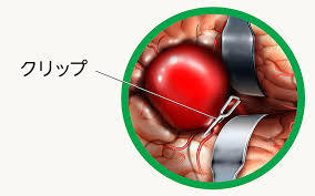 Maybe you would like to learn more about one of these? ãã‚‚è†œä¸‹å‡ºè¡€ã®æ²»ç™‚ã«ã¤ã„ã¦ åŒ—é'å±±dã‚¯ãƒªãƒ‹ãƒƒã‚¯ ã‚­ãƒ¬ãƒ¼ã‚·ãƒ§ãƒ³ç™‚æ³•éƒ¨é–€