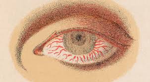 Image result for Neurosyphilis