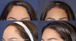 See what natural hairy women (hairywomen) has discovered on pinterest, the world's biggest collection of ideas. Dr Jason Champagne Hairline Lowering Before And After Forehead Reduction Anti Hair Loss Hairline