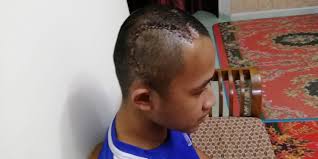 Cedera kepala cedera kepala juga menjadi penyebab penggumpalan darah di otak dan juga menimbulkan gejala gegar otak. Remaja Aktif Sukan Selamat Jalani Pembedahan Ke 2 Buang Darah Beku Di Kepala Remaja