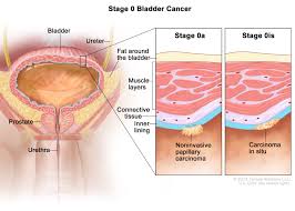 Usually, the early stages of bladder cancer (when it's small and only in the bladder) cause bleeding but little or no pain or other symptoms. Bladder Cancer Treatment Pdq Patient Version National Cancer Institute