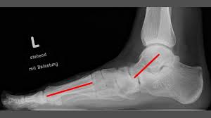 Maybe you would like to learn more about one of these? Knick Senk Fuss Ogam Orthopadie