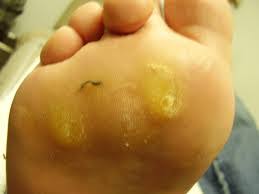 Maybe you would like to learn more about one of these? Callus And Corns What Is The Difference Foot Factor Podiatry