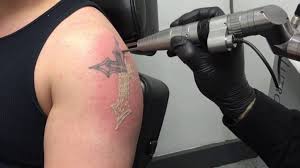 I saw major results, but i went to a laser tattoo removal consultant three weeks after getting the tree tattoo. Remove Permanent Tattoos With Laser Tattoo Removal Procedures Wellbeing Clinic