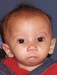 Image result for Micrognathia