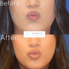 Keep the head elevated for the first night to prevent any additional swelling. Lip Filler After Care Instructions Homes Of Heaven