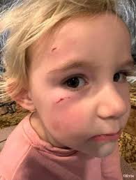 A rooster scratched up their little girl, but she had the last laugh