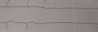 Ecg &cardiac arrestcardiac arrestcpr aha changes. Asystole Wikipedia