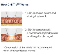 Laser hair removal is the process of hair removal by means of exposure to pulses of laser light that destroy the hair follicle. The Truth About Laser Hair Removal All Of Your Questions Answered Derma Health Institute