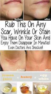 Rub This On Any Scar Wrinkle Or Stain You Have On Your Skin And Enjoy Them Disappear In Minutes Even Docto How To Get Rid Of Acne Skin Remedies Acne Remedies