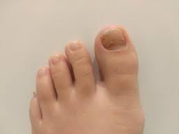 We did not find results for: How To Get Rid Of Toenail Fungus Reddit