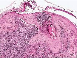 Inflammatory Diseases Of Hair Follicles Sweat Glands And Cartilage Plastic Surgery Key