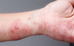 Image result for scabies transmission
