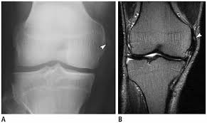 Pellegrini stieda syndrome is a medical problem which is characterized by pain, swelling and inflammation in the knee. Xmlinkhub