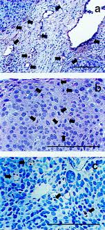 Learn how to manage your relationships and communicate with those around you after being diagnosed facing cancer with your loved ones. Changes In Tumor Oxygen Tension During Radiotherapy Of Uterine Cervical Cancer Relationships To Changes In Vascular Density Cell Density And Frequency Of Mitosis And Apoptosis International Journal Of Radiation Oncology Biology