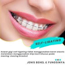 Check spelling or type a new query. Jenis Jenis Kawat Gigi Saat Ini