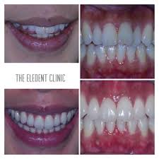 Piranhas have a reputation for being some of the more ferocious fish in the world. Get A Healthy Smile Dental Check Ups In Sutton Eledent Dentist In Sutton Family And Aesthetic Dentistry Eledent Dentist In Sutton